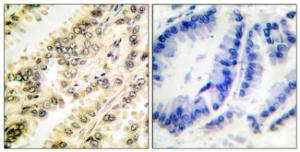 Immunohistochemical analysis of paraffin-embedded human breast carcinoma using Anti-SGK (phospho Ser422) Antibody. The right hand panel represents a negative control, where the antibody was pre-incubated with the immunising peptide.