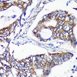 Immunohistochemistry analysis of paraffin-embedded human colon carcinoma tissue using Anti-ALG5 Antibody (A307584) at a dilution of 1:100 (40x lens). Perform microwave antigen retrieval with 10 mM PBS buffer pH 7.2 before commencing with IHC staining protocol.