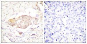 Immunohistochemical analysis of paraffin-embedded human breast cancer using Anti-SGK (phospho Ser422) Antibody 1:100 (4°C overnight). The right hand panel represents a negative control, where the antibody was pre-incubated with the immunising peptide.