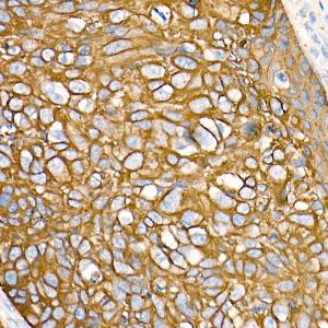 Immunohistochemistry analysis of paraffin-embedded human esophageal cancer using Anti-Cytokeratin 19 Antibody [ARC0272] (A308569) at a dilution of 1:100 (40x lens) Perform microwave antigen retrieval with 10 mM PBS buffer pH 72 before commencing with IHC staining protocol