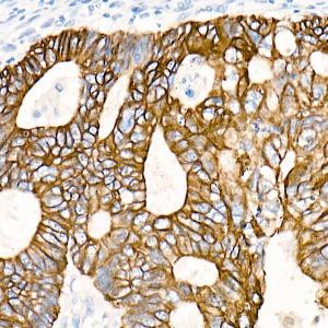 Immunohistochemistry analysis of paraffin-embedded human colon carcinoma tissue using Anti-Cytokeratin 19 Antibody [ARC0272] (A308569) at a dilution of 1:100 (40x lens) Perform microwave antigen retrieval with 10 mM PBS buffer pH 72 before commencing with IHC staining protocol