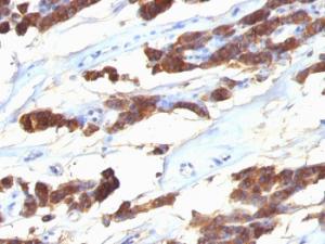 Immunohistochemical analysis of formalin-fixed, paraffin-embedded human thyroid carcinoma using Anti-Thyroglobulin Antibody [SPM221]