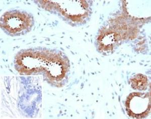 Immunohistochemical analysis of formalin-fixed, paraffin-embedded human breast carcinoma tissue using Anti-BAP1 Antibody [BAP1/6861R]. Inset: PBS instead of the primary Antibody. Secondary Antibody negative control