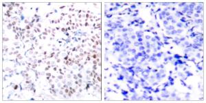 Immunohistochemical analysis of paraffin-embedded human breast carcinoma using Anti-Myc (phospho Thr358) Antibody. The right hand panel represents a negative control, where the antibody was pre-incubated with the immunising peptide