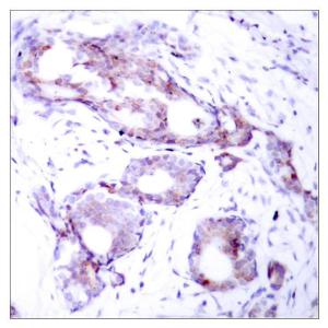 Immunohistochemical analysis of paraffin-embedded human breast carcinoma using Anti-Myc (phospho Ser373) Antibody