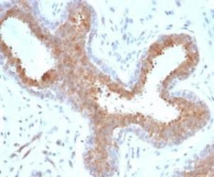 Immunohistochemical analysis of formalin-fixed, paraffin-embedded human breast carcinoma tissue using Anti-BAP1 Antibody [BAP1/6861R]