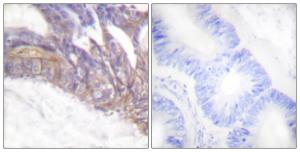 Immunohistochemical analysis of paraffin-embedded human colon carcinoma using Anti-LAT (phospho Tyr191) Antibody The right hand panel represents a negative control, where the antibody was pre-incubated with the immunising peptide