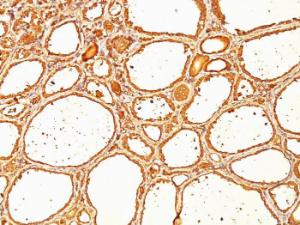 Immunohistochemical analysis of formalin-fixed, paraffin-embedded human thyroid carcinoma using Anti-Thyroglobulin Antibody [SPM517]