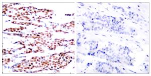 Immunohistochemical analysis of paraffin-embedded human breast carcinoma using Anti-JunB (phospho Ser79) Antibody. The right hand panel represents a negative control, where the antibody was pre-incubated with the immunising peptide