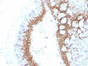 Immunohistochemical analysis of formalin-fixed, paraffin-embedded human colon carcinoma using Anti-SATB2 Antibody [SATB2/4374R]