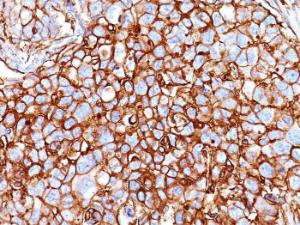 Immunohistochemical analysis of formalin-fixed, paraffin-embedded human breast carcinoma using Anti-CD44 Antibody [HCAM/918]