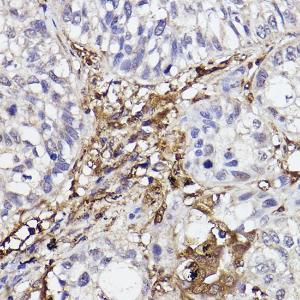 Immunohistochemistry analysis of paraffin-embedded human lung cancer using Anti-GBP1 Antibody [ARC2521] (A308580) at a dilution of 1:100 (40x lens) Perform high pressure antigen retrieval with 10 mM citrate buffer pH 60 before commencing with IHC staining protocol