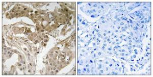 Immunohistochemical analysis of paraffin-embedded human breast carcinoma using Anti-FOS (phospho Thr232) Antibody. The right hand panel represents a negative control, where the antibody was pre-incubated with the immunising peptide