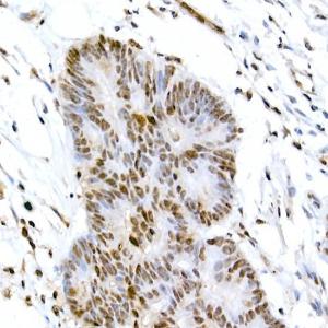 Immunohistochemistry analysis of paraffin-embedded human colon carcinoma tissue using Anti-CREB (phospho Ser133) Antibody (A10868) at a dilution of 1:100 (40x lens). Perform high pressure antigen retrieval with 10 mM citrate buffer pH 6.0 before commencing with IHC staining protocol.