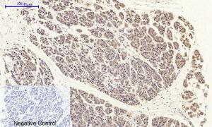 Immunohistochemical analysis of paraffin-embedded human stomach cancer tissue using Anti-FAK (phospho Tyr397) Antibody at 1:200 (4°C overnight). Negative control was secondary antibody only