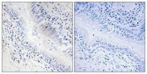 Immunohistochemical analysis of paraffin-embedded human lung cancer using Anti-DNAL1 Antibody 1:100 (4°C overnight). The right hand panel represents a negative control, where the antibody was pre-incubated with the immunising peptide