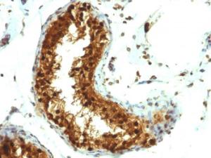 Immunohistochemical analysis of formalin-fixed, paraffin-embedded human testicular carcinoma using Anti-SUMO-1 Antibody [SUMO1/1188]