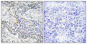 Immunohistochemical analysis of paraffin-embedded human lung cancer using Anti-DNAL1 Antibody 1:100 (4°C overnight). The right hand panel represents a negative control, where the antibody was pre-incubated with the immunising peptide