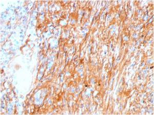 Immunohistochemical analysis of formalin-fixed, paraffin-embedded human lung using Anti-Fibronectin Antibody [FN1/3045]