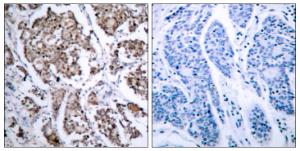 Immunohistochemical analysis of paraffin-embedded human breast carcinoma using Anti-BAD (phospho Ser155) Antibody The right hand panel represents a negative control, where the antibody was pre-incubated with the immunising peptide