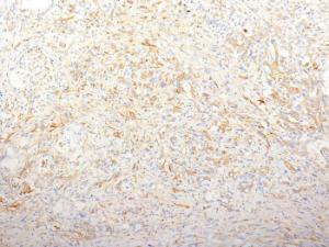 Immunohistochemical analysis of formalin-fixed, paraffin-embedded human pancreatic adenocarcinoma using Anti-Fibronectin Antibody [TV-1]