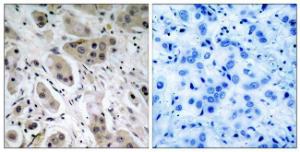 Immunohistochemical analysis of paraffin-embedded human breast carcinoma using Anti-Akt (phospho Ser473) Antibody. The right hand panel represents a negative control, where the antibody was pre-incubated with the immunising peptide