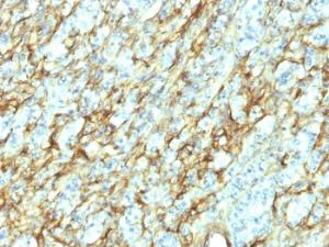 Immunohistochemical analysis of formalin-fixed, paraffin-embedded human renal cell carcinoma using Anti-Fibronectin Antibody [568]