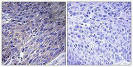 Immunohistochemical analysis of paraffin-embedded human lung cancer using Anti-GFM2 Antibody 1:100 (4°C overnight) The right hand panel represents a negative control, where the antibody was pre-incubated with the immunising peptide