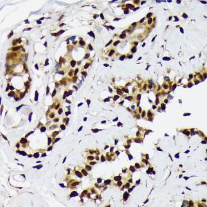 Immunohistochemistry analysis of paraffin-embedded human breast cancer tissue using Anti-ILF2 / NF45 Antibody [ARC1621] (A308598) at a dilution of 1:100 (40x lens). Perform microwave antigen retrieval with 10 mM Tris/EDTA buffer pH 9.0 before commencing with IHC staining protocol.