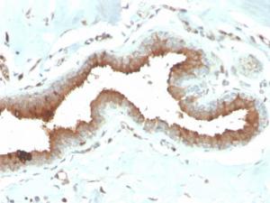 Immunohistochemical analysis of formalin-fixed, paraffin-embedded human breast carcinoma using Anti-Mammaglobin A Antibody [MGB/2704]