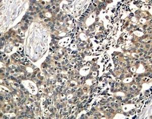 Immunohistochemistry analysis of paraffin-embedded human breast carcinoma tissue using Anti-DOK2 (phospho Tyr299) Antibody (A10905). Perform microwave antigen retrieval with 10 mM Tris/EDTA buffer pH 9.0 before commencing with IHC staining protocol