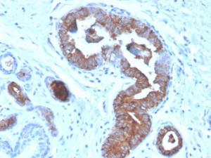 Immunohistochemical analysis of formalin-fixed, paraffin-embedded human breast carcinoma using Anti-Mammaglobin A Antibody [MGB/4056]