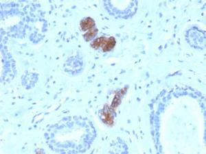 Immunohistochemical analysis of formalin-fixed, paraffin-embedded human breast carcinoma using Anti-Mammaglobin A Antibody [MGB/4056]