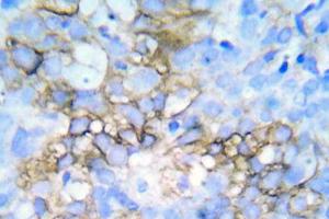 Immunohistochemical analysis of paraffin-embedded human breast carcinoma tissue using Anti-HSP27 (phospho Ser78 + Ser82) Antibody