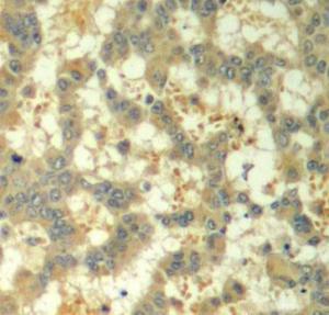 Immunohistochemistry analysis of paraffin-embedded human breast carcinoma tissue using Anti-Syk (phospho Tyr323) Antibody (A10913). Perform microwave antigen retrieval with 10 mM Tris/EDTA buffer pH 9.0 before commencing with IHC staining protocol