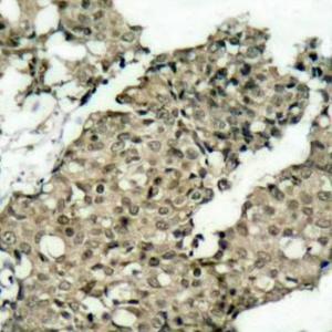 Immunohistochemistry analysis of paraffin-embedded human breast carcinoma tissue using Anti-G3BP (phospho Ser232) Antibody (A10934). Perform microwave antigen retrieval with 10 mM Tris/EDTA buffer pH 9.0 before commencing with IHC staining protocol.