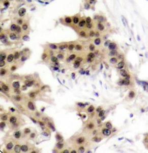 Immunohistochemistry analysis of paraffin-embedded human breast carcinoma tissue using Anti-NFkB p105 / p50 (phospho Ser893) Antibody (A10945). Perform microwave antigen retrieval with 10 mM Tris/EDTA buffer pH 9.0 before commencing with IHC staining protocol.