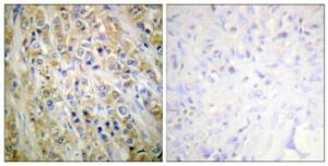 Immunohistochemical analysis of paraffin-embedded human prostate carcinoma tissue using Anti-Prostate-specific Antigen Antibody. The right hand panel represents a negative control, where the antibody was pre-incubated with the immunising peptide.