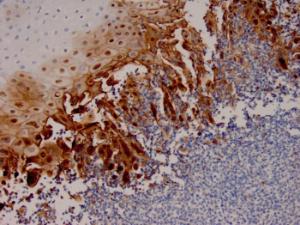 Immunohistochemical analysis of formalin-fixed, paraffin-embedded human esophageal carcinoma tissue using Anti-HSV1 Antibody [HSV1/4055R]