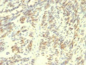 Immunohistochemical analysis of formalin-fixed, paraffin-embedded human leiomyosarcoma using Anti-Transglutaminase II Antibody [SPM358]