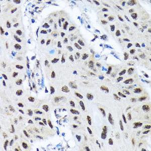 Immunohistochemistry analysis of paraffin-embedded human lung cancer using Anti-SMN/Ge min 1 Antibody [ARC1710] (A308623) at a dilution of 1:100 (40X lens). Perform microwave antigen retrieval with 10 mM Tris/EDTA buffer pH 9.0 before commencing with IHC staining protocol