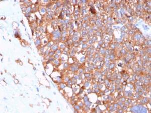 Immunohistochemical analysis of formalin-fixed, paraffin-embedded human urothelial carcinoma using Anti-Uroplakin 1B Antibody [UPK1B/3102]