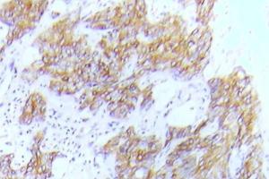 Immunohistochemical analysis of paraffin-embedded human lung adenocarcinoma tissue using Anti-Flt-3 (phospho Tyr591) Antibody