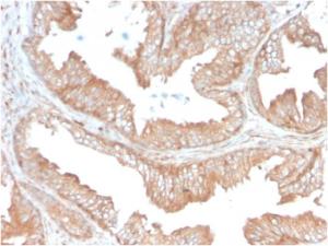 Immunohistochemical analysis of formalin-fixed, paraffin-embedded human prostate carcinoma using Anti-CD47 Antibody [CD47/3019]