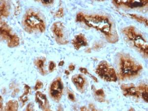 Immunohistochemical analysis of formalin-fixed, paraffin-embedded human prostate carcinoma using Anti-PSMA Antibody [SPM500]