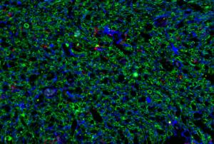 This antibody stained human brain stroke (including control cortex and stroke core areas) tissue. The primary antibody was incubated at 2.5 mg/ml overnight at 4?C. This was followed by a fluorophore conjugated secondary antibody. Optimal concentrations and conditions may vary.