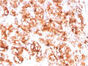 Immunohistochemical analysis of formalin-fixed, paraffin-embedded human prostate carcinoma using Anti-PSMA Antibody [FOLH1/3734]