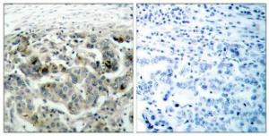 Immunohistochemical analysis of paraffin-embedded human breast carcinoma tissue using Anti-NF kappa B p105/p50 Antibody. The right hand panel represents a negative control, where the antibody was pre-incubated with the immunising peptide