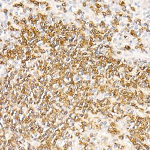 Immunohistochemistry analysis of paraffin-embedded human nodular Hodgkin lymphoma using Anti-CD79a Antibody [ARC0482] (A307607) at a dilution of 1:100 (40x lens)