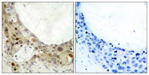 Immunohistochemical analysis of paraffin-embedded human breast carcinoma using Anti-BCL-2 (phospho Ser70) Antibody. The right hand panel represents a negative control, where the antibody was pre-incubated with the immunising peptide.